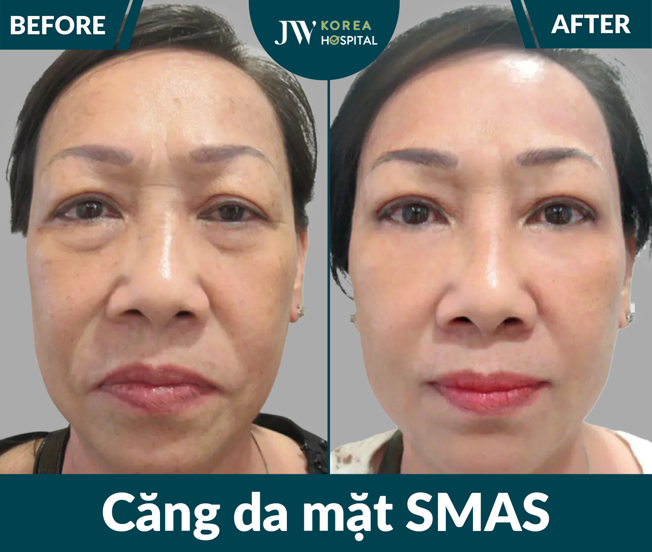Căng da mặt SMAS PRO
