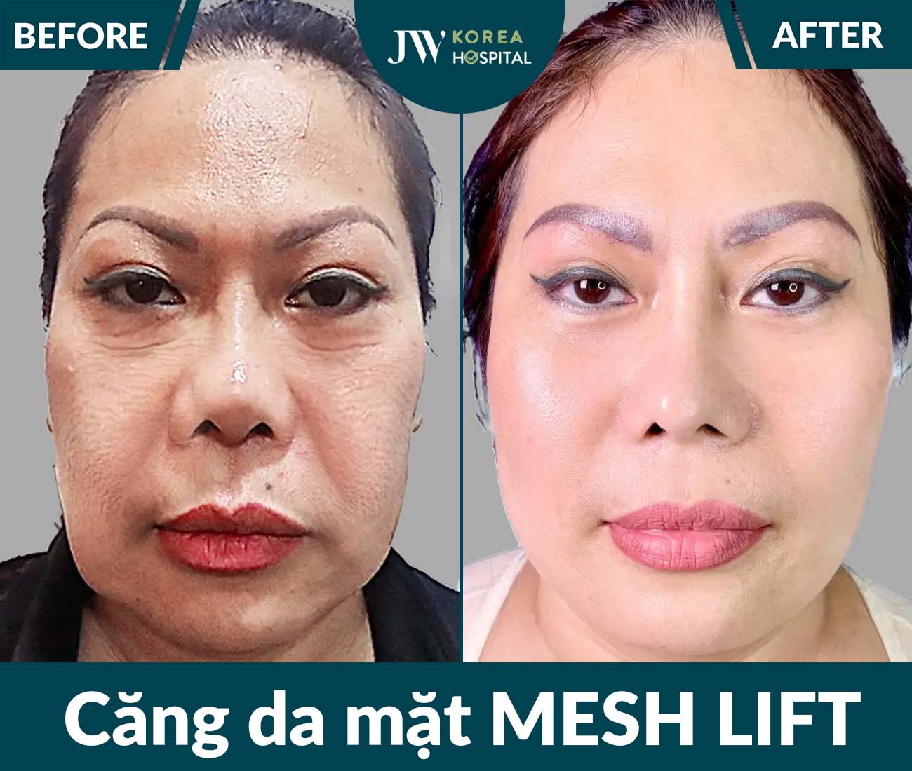 Căng da mặt SMAS PRO
