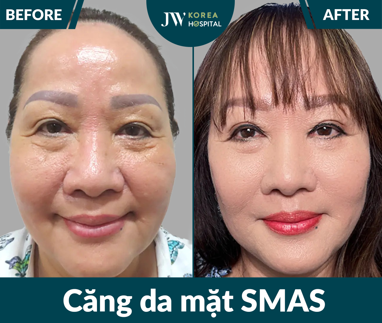 Căng da mặt SMAS PRO