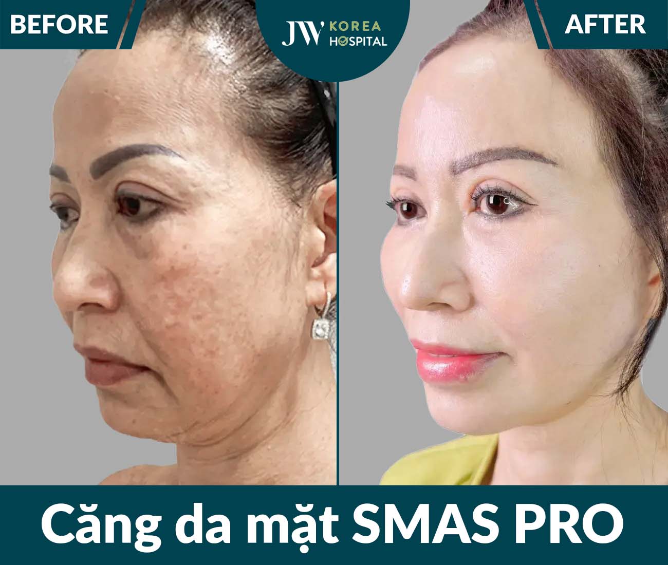 Căng da mặt SMAS PRO