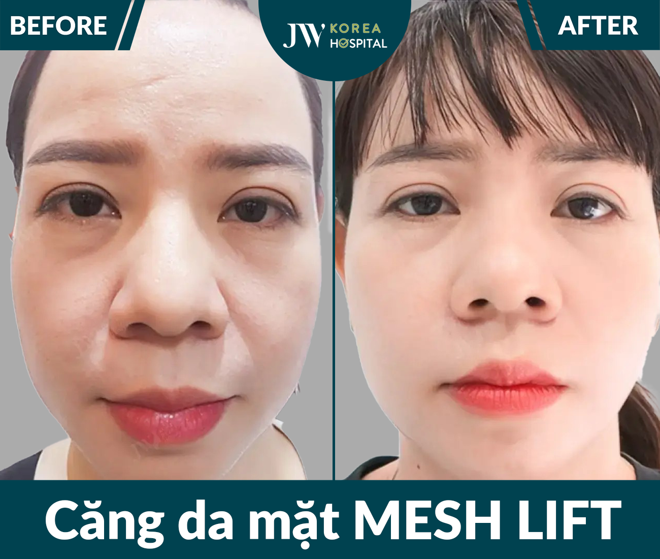 Căng chỉ Meshlift