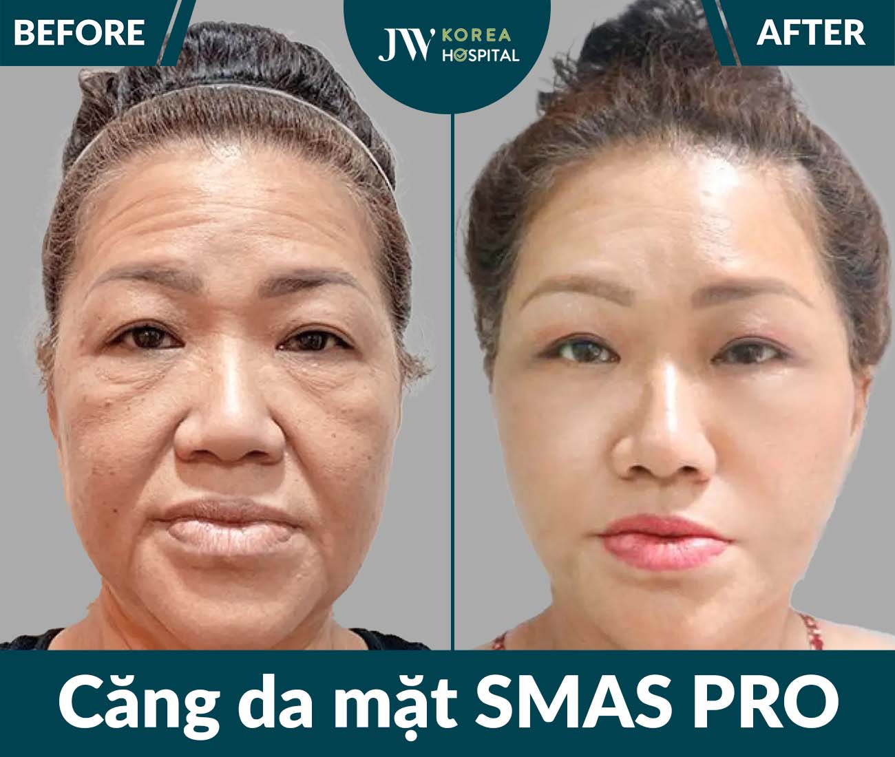 Căng da mặt SMAS PRO