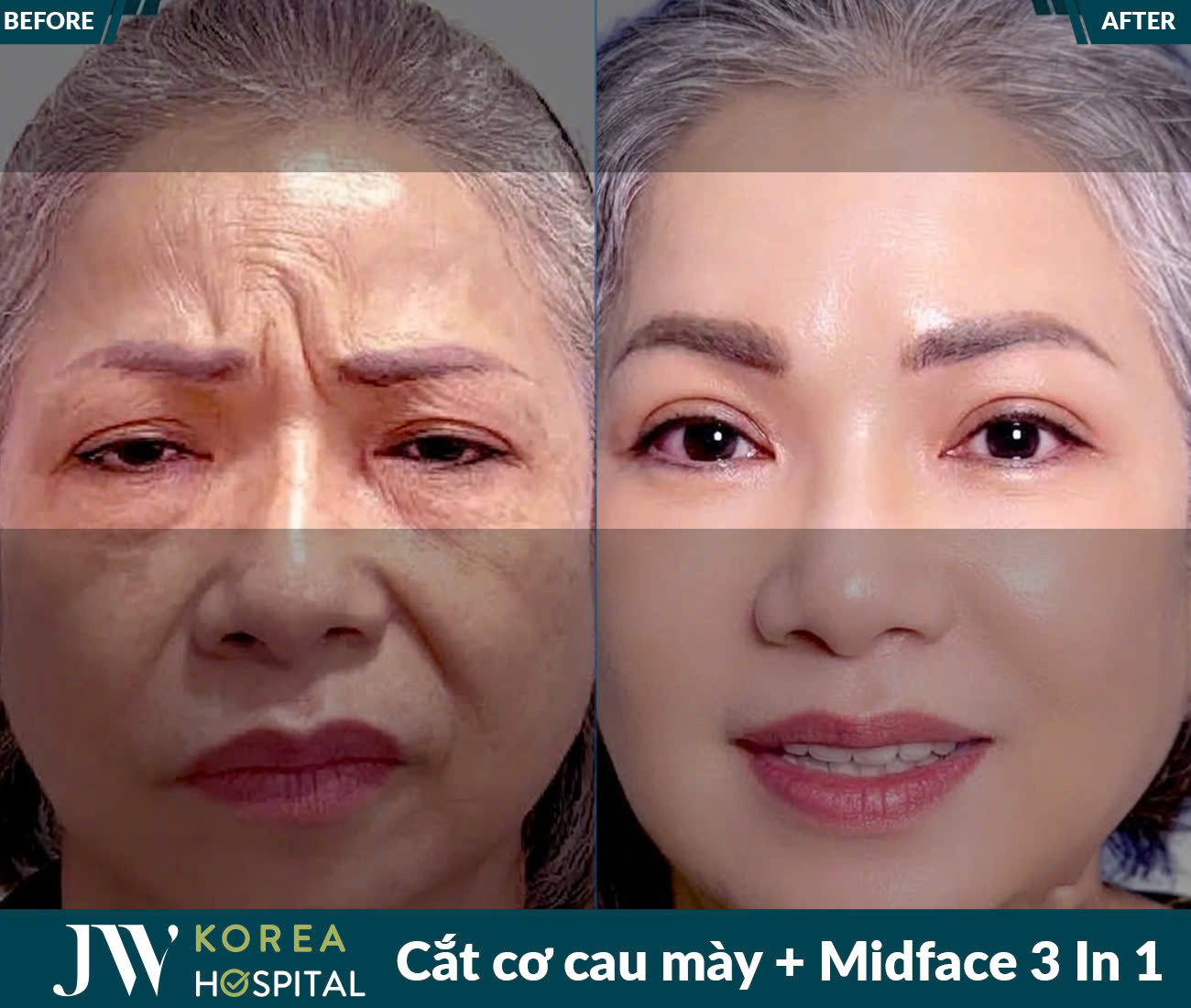 Cắt cơ cau mày nội soi