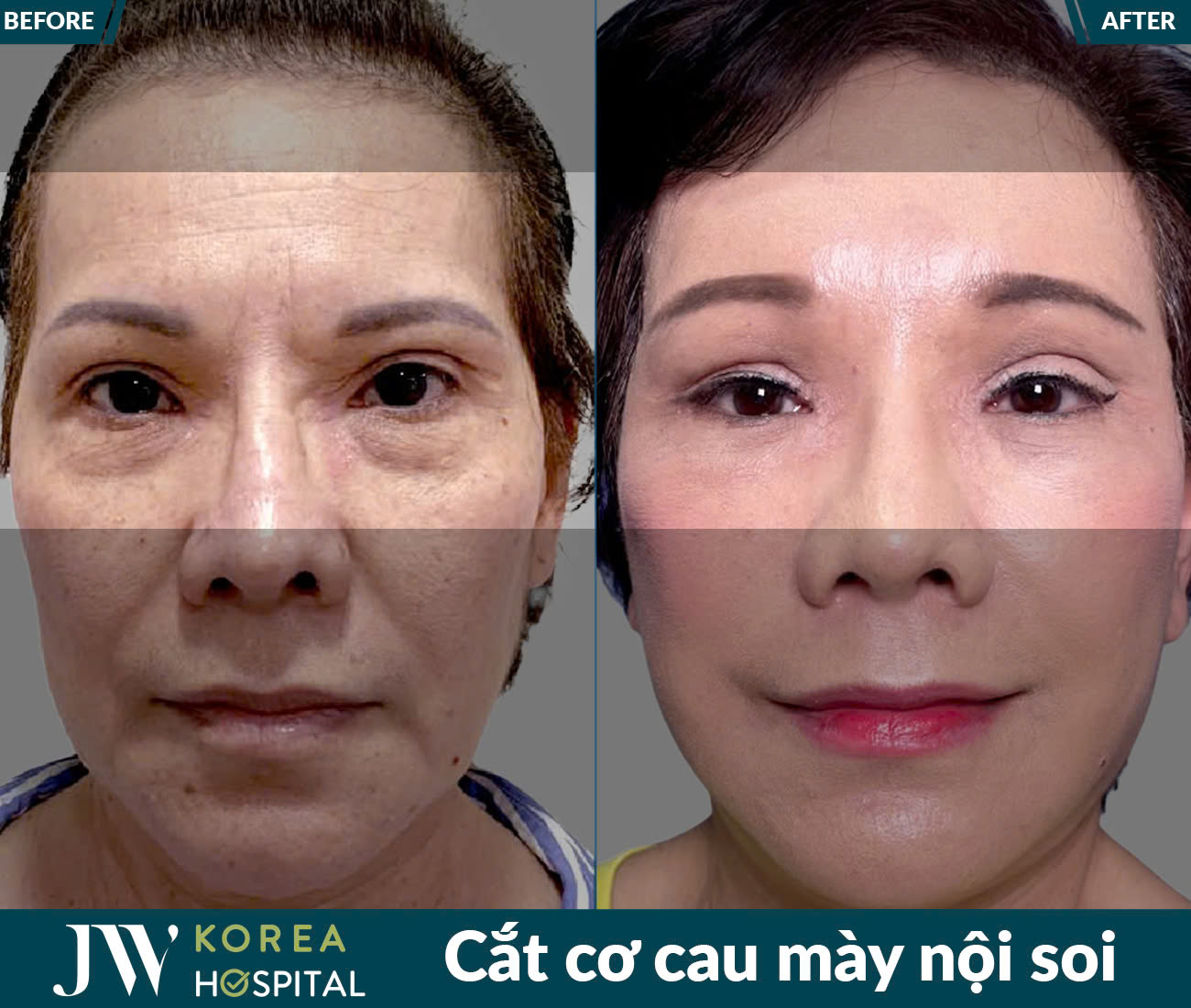 Cắt cơ cau mày nội soi