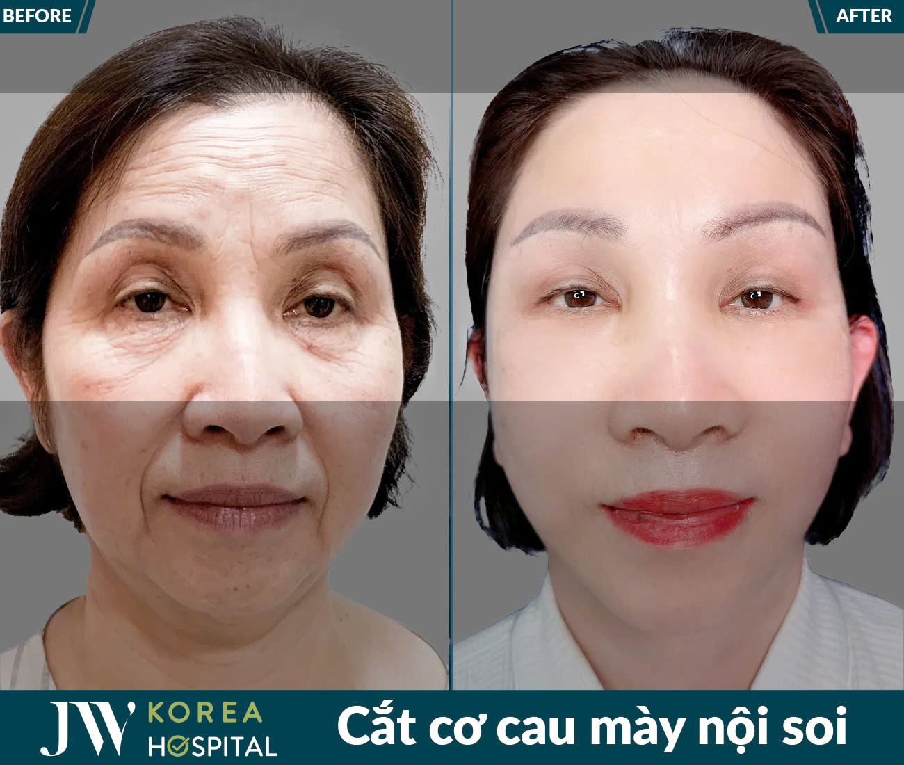 Cắt cơ cau mày nội soi
