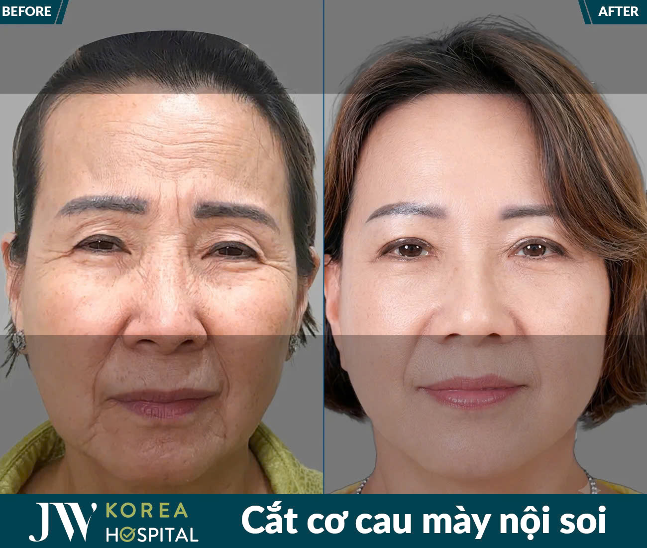 Cắt cơ cau mày nội soi
