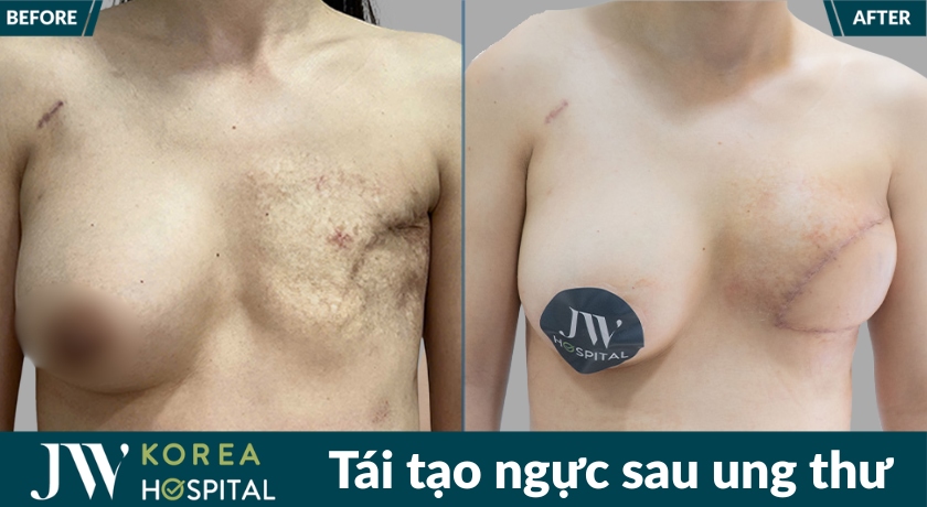 Kết quả trước và sau của khách hàng sau tái tạo ngực tại bệnh viện JW sau ung thư vú