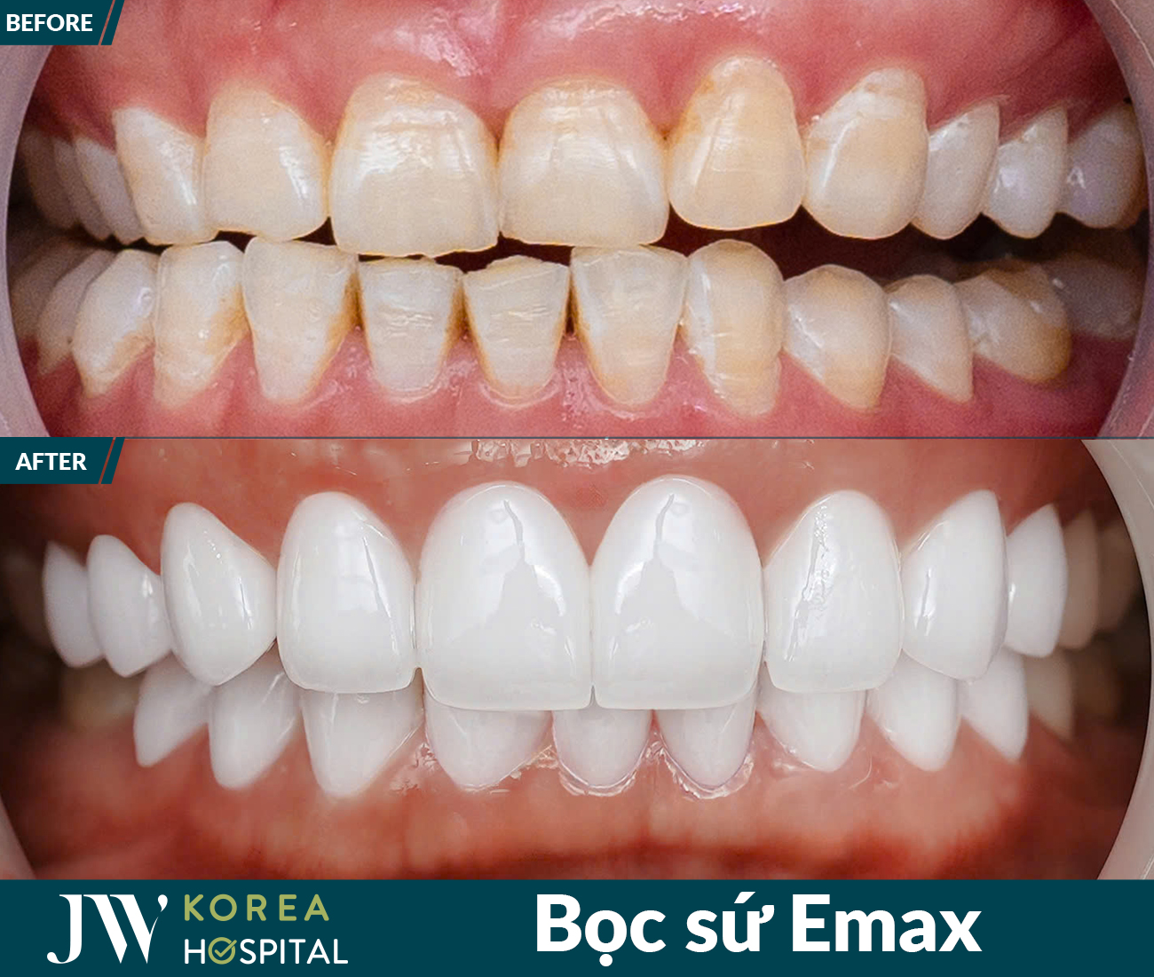 Thẩm mỹ răng sứ