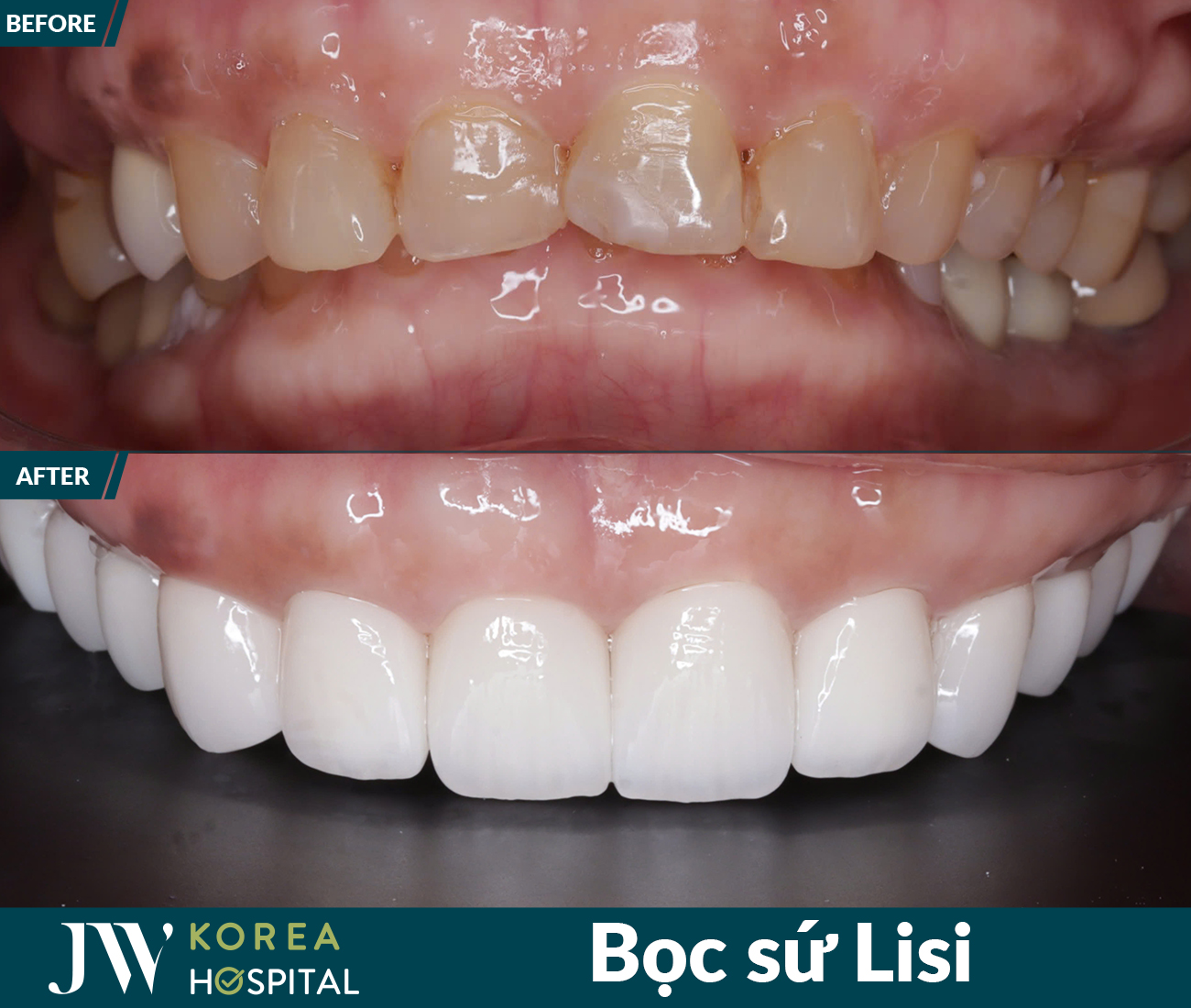 Thẩm mỹ răng sứ