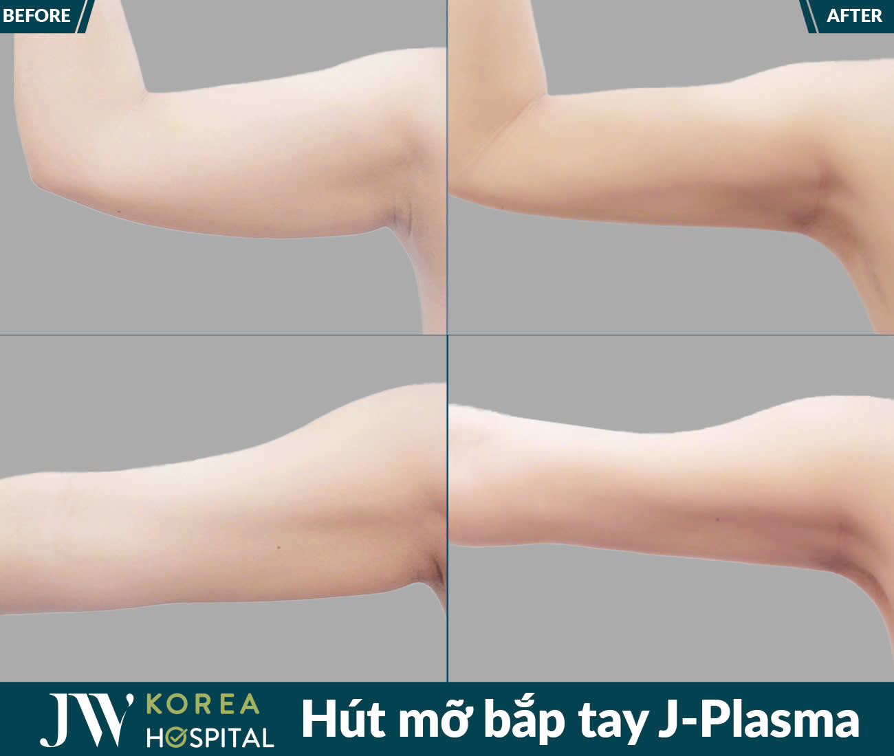 Dịch vụ giảm béo