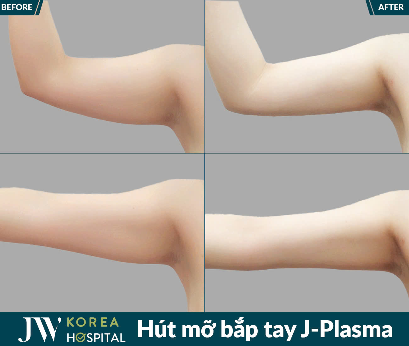 Dịch vụ giảm béo