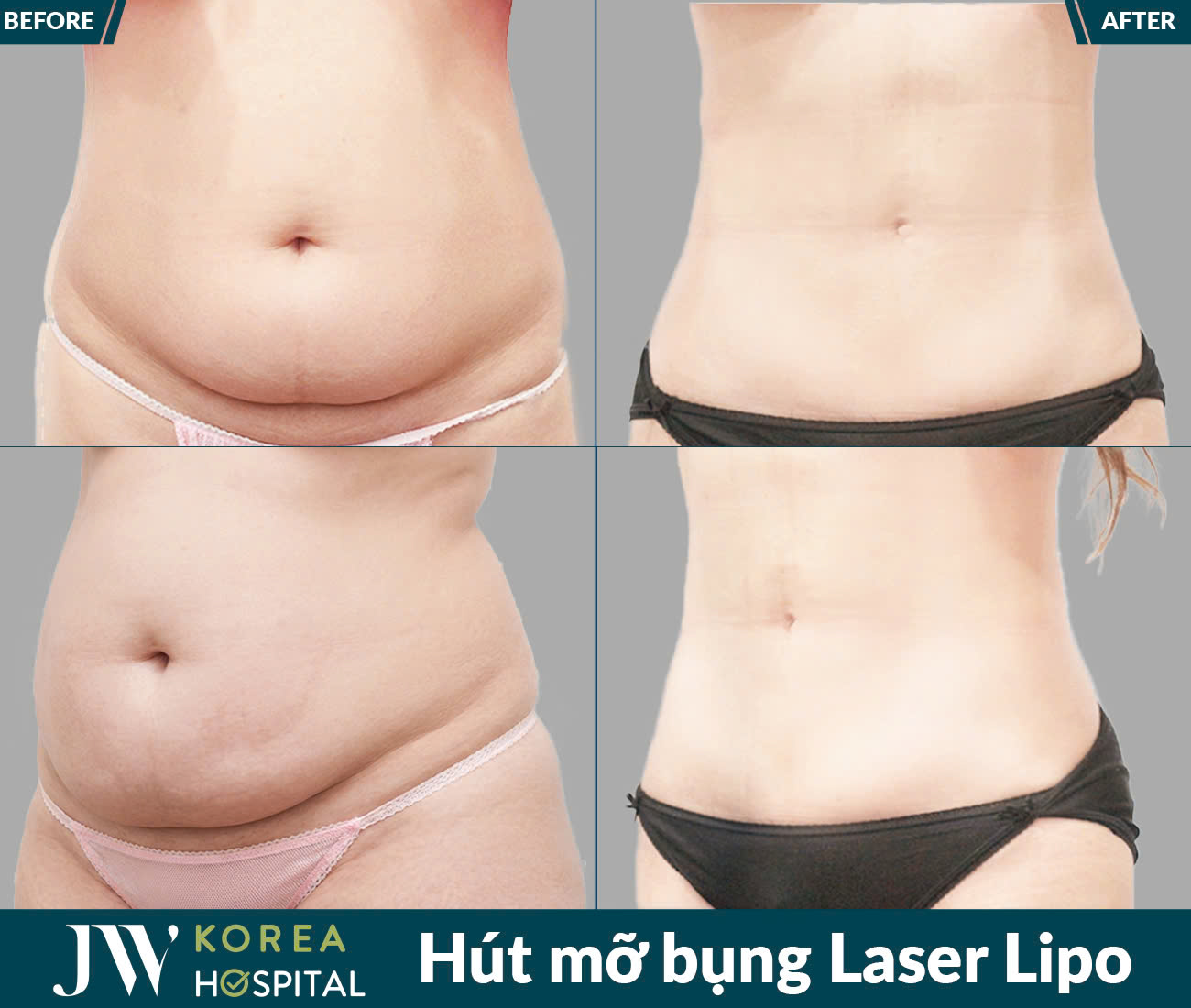 Dịch vụ giảm béo