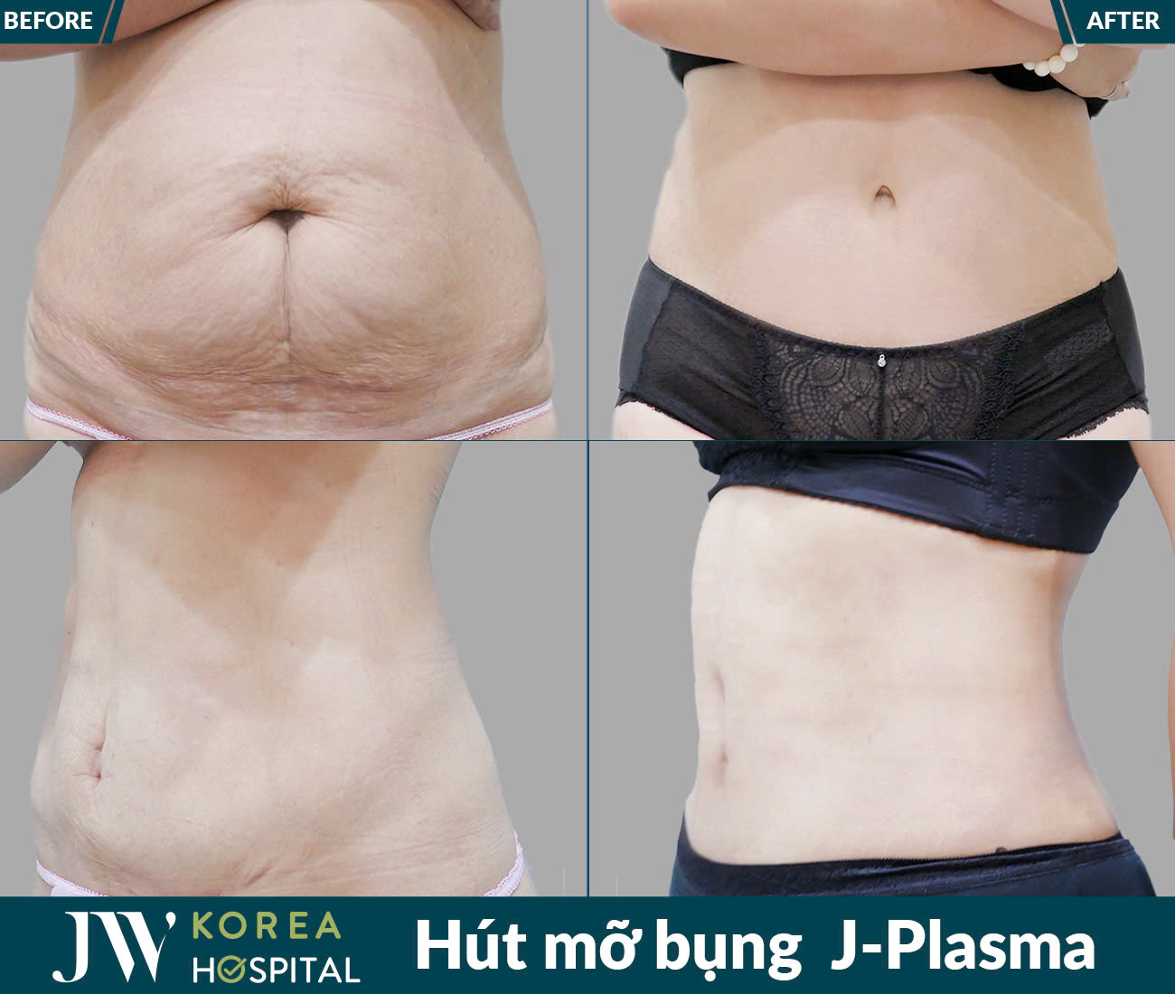 Dịch vụ giảm béo