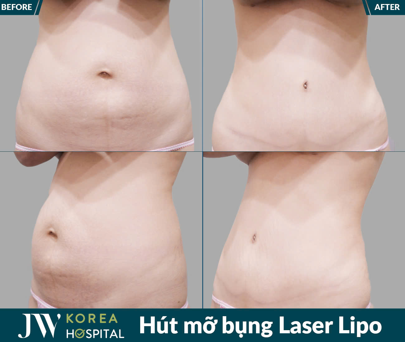 Dịch vụ giảm béo