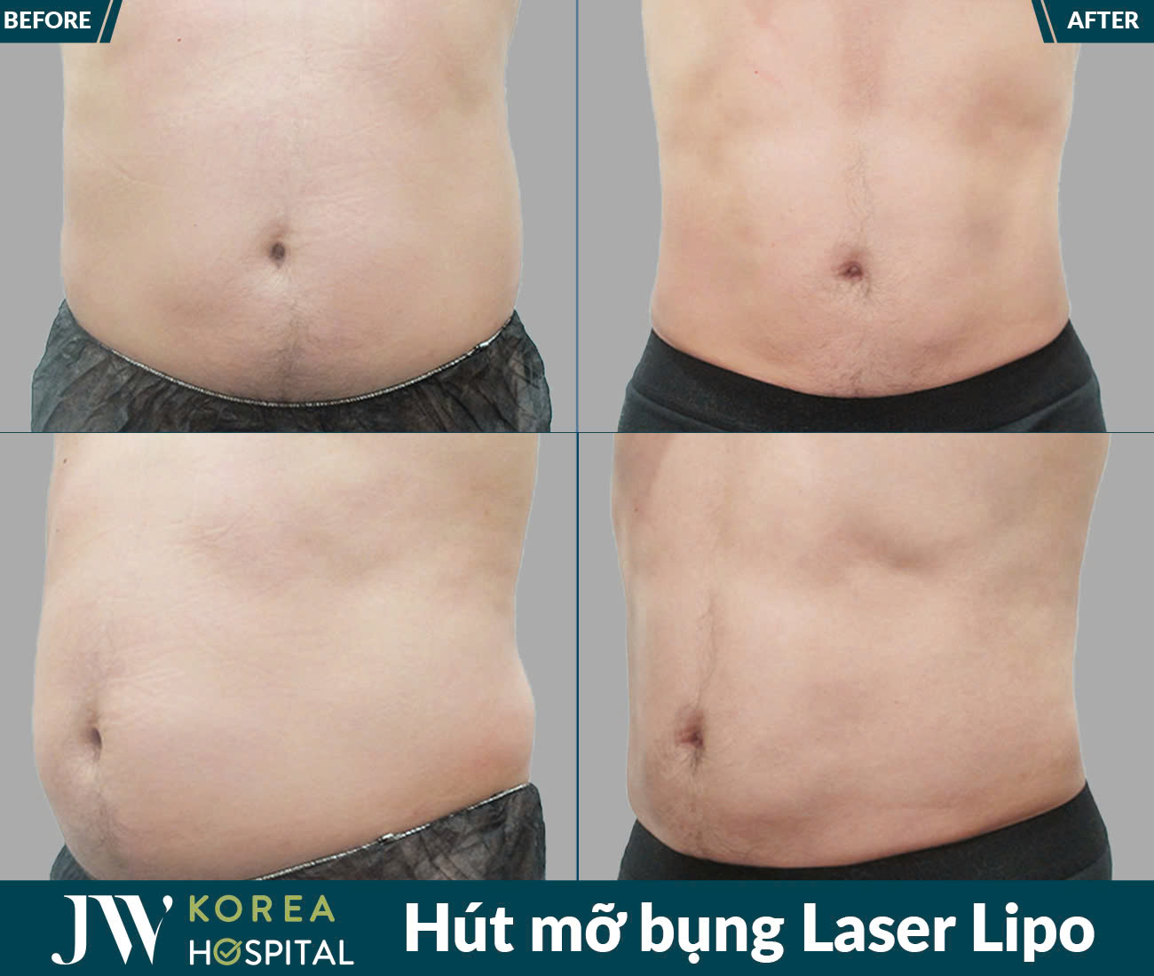 Dịch vụ giảm béo