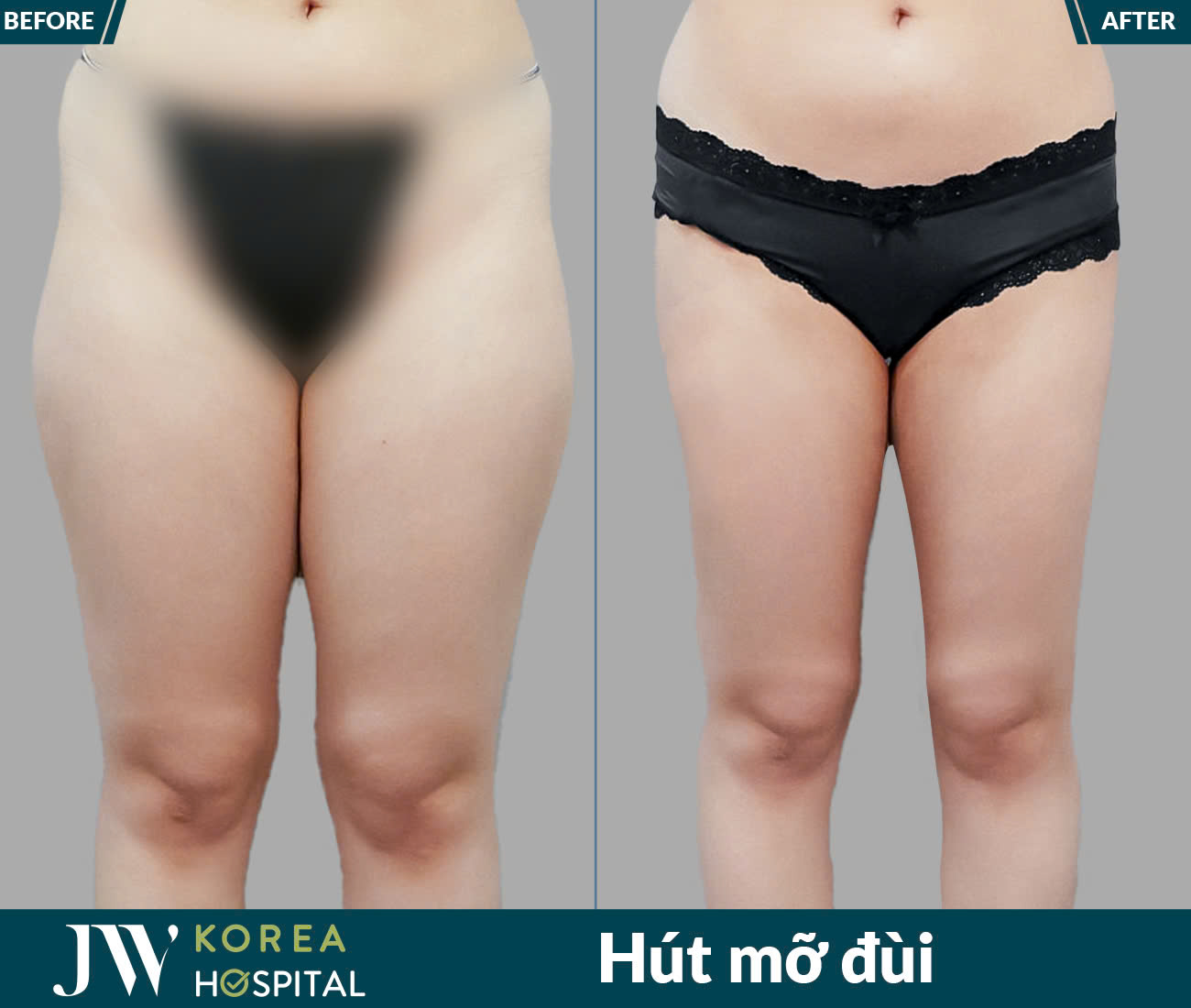 Dịch vụ giảm béo