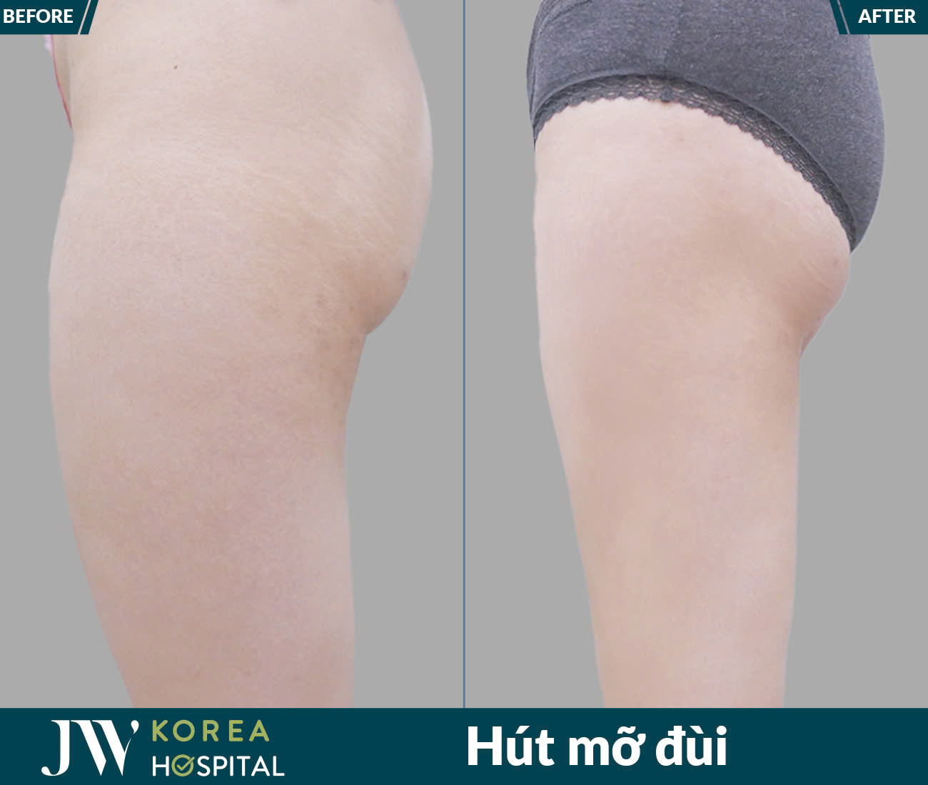 Dịch vụ giảm béo