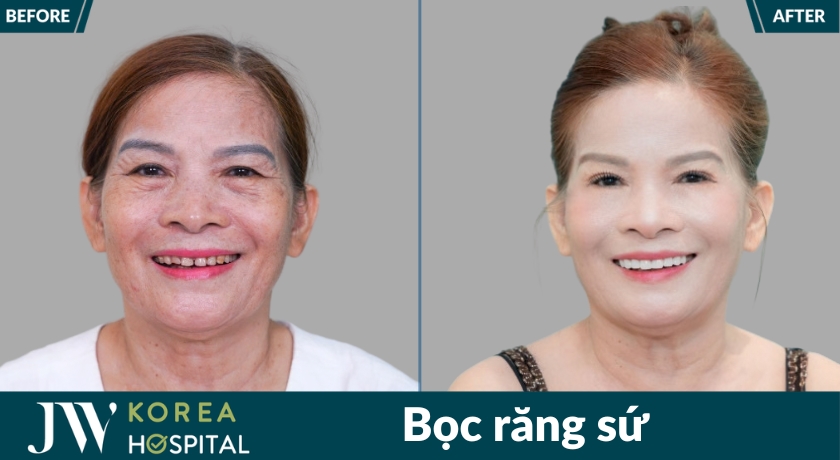 Kết quả hình ảnh trước và sau bọc răng sứ tại bệnh viện JW