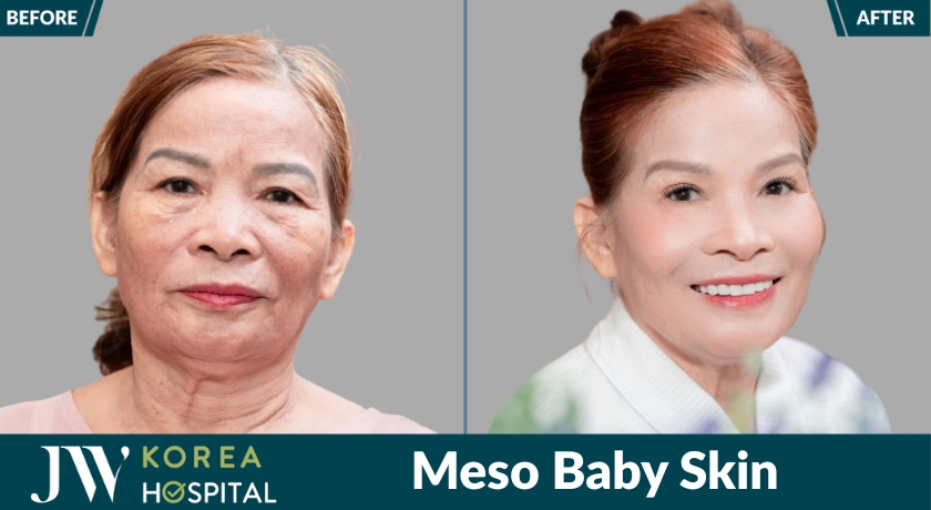 Kết quả trước và sau tiêm meso baby skin tại bệnh viện jw