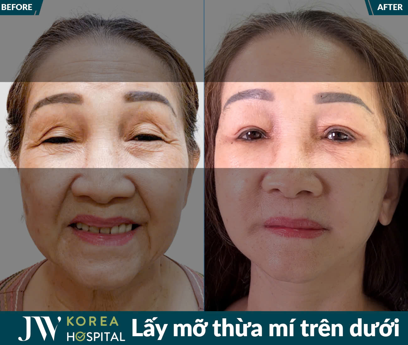 Lấy mỡ da thừa mắt