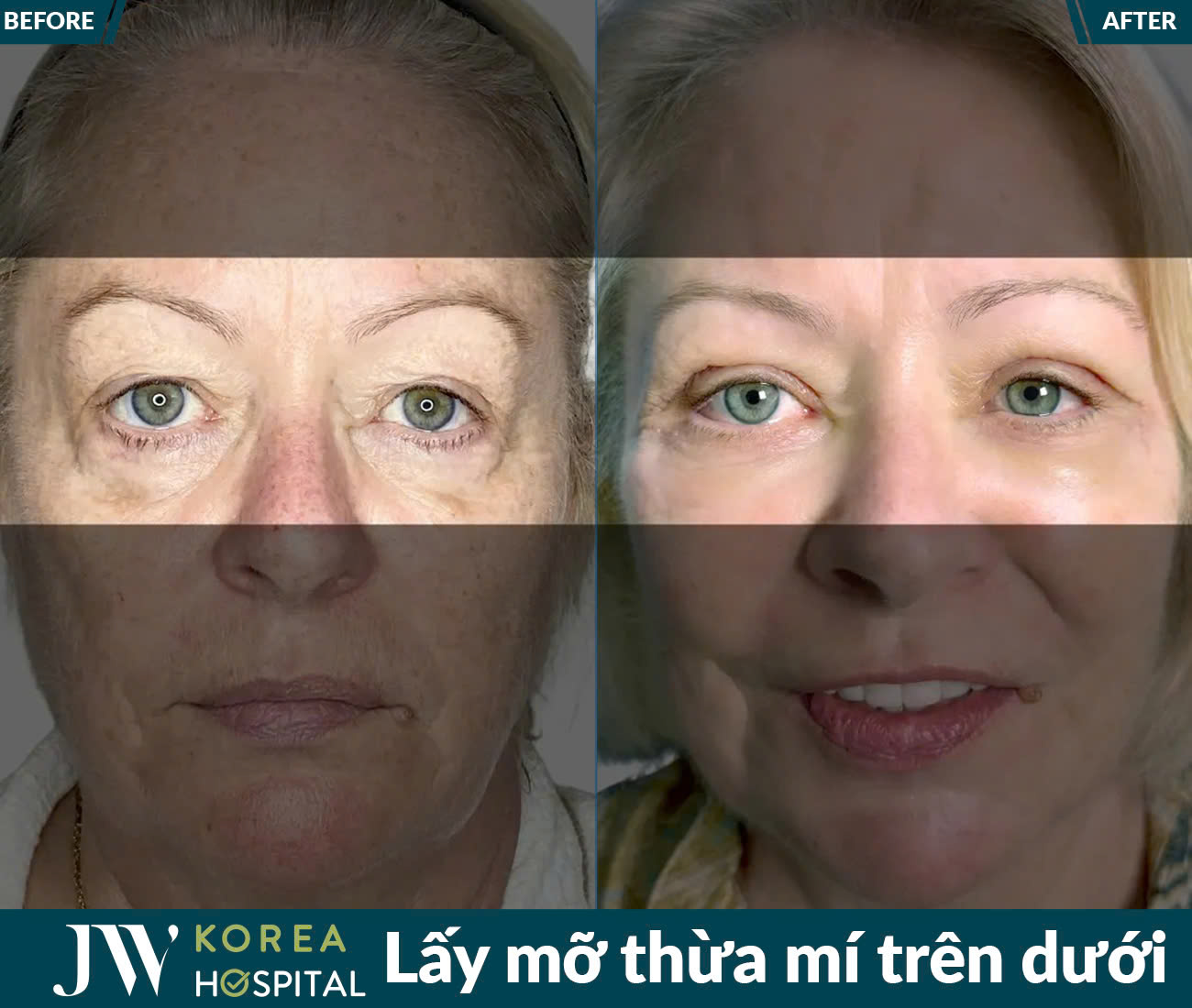 Lấy mỡ da thừa mắt