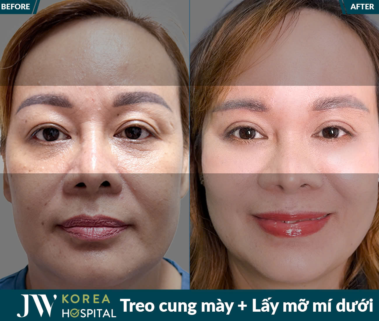 Lấy mỡ da thừa mắt