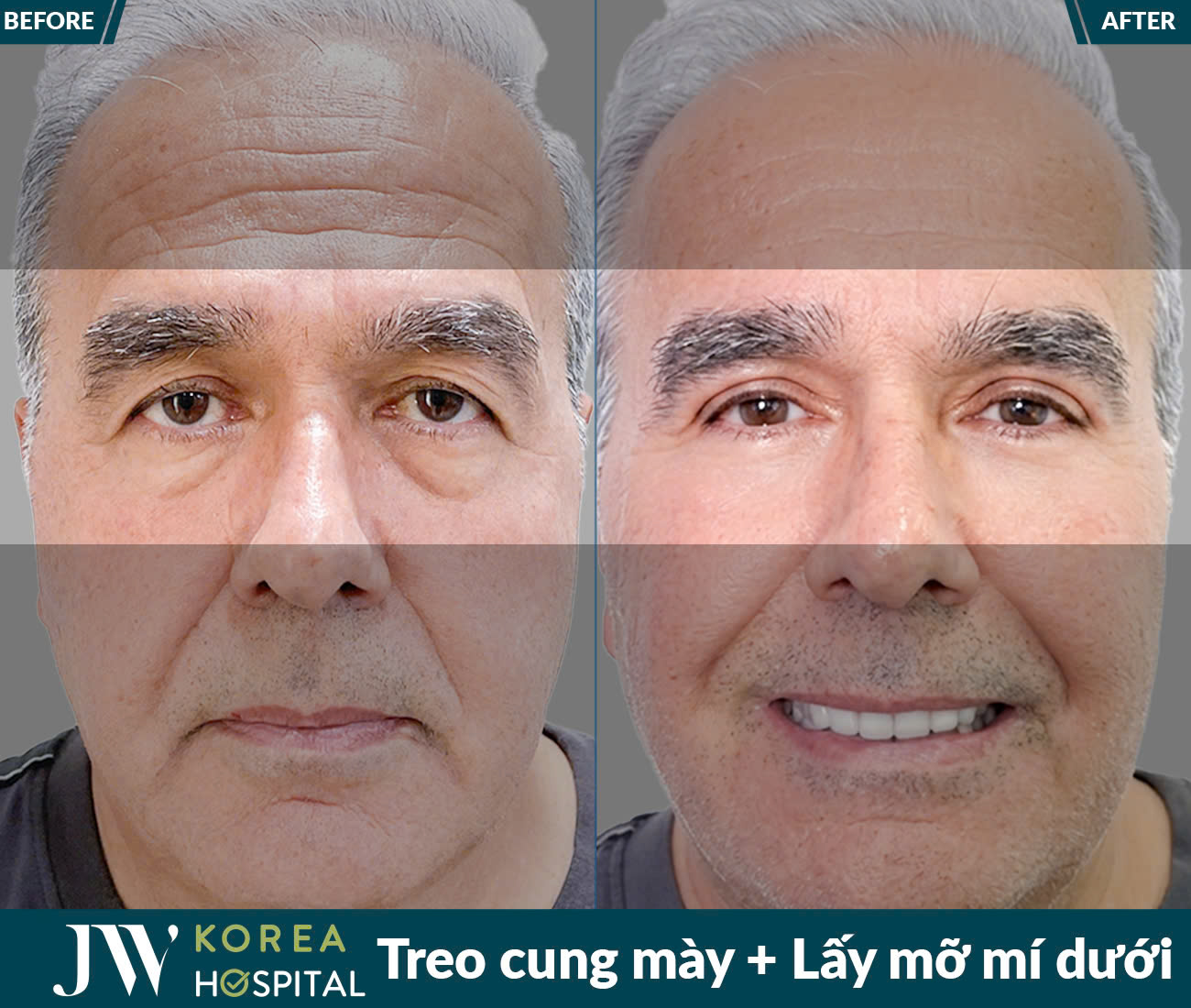 Lấy mỡ da thừa mắt