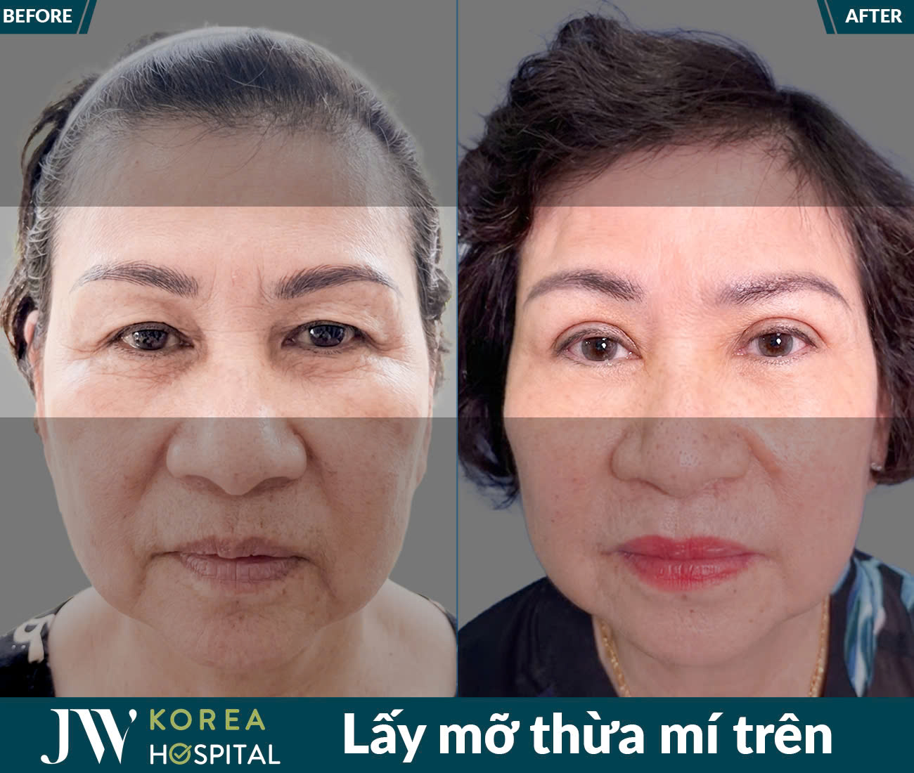 Lấy mỡ da thừa mắt