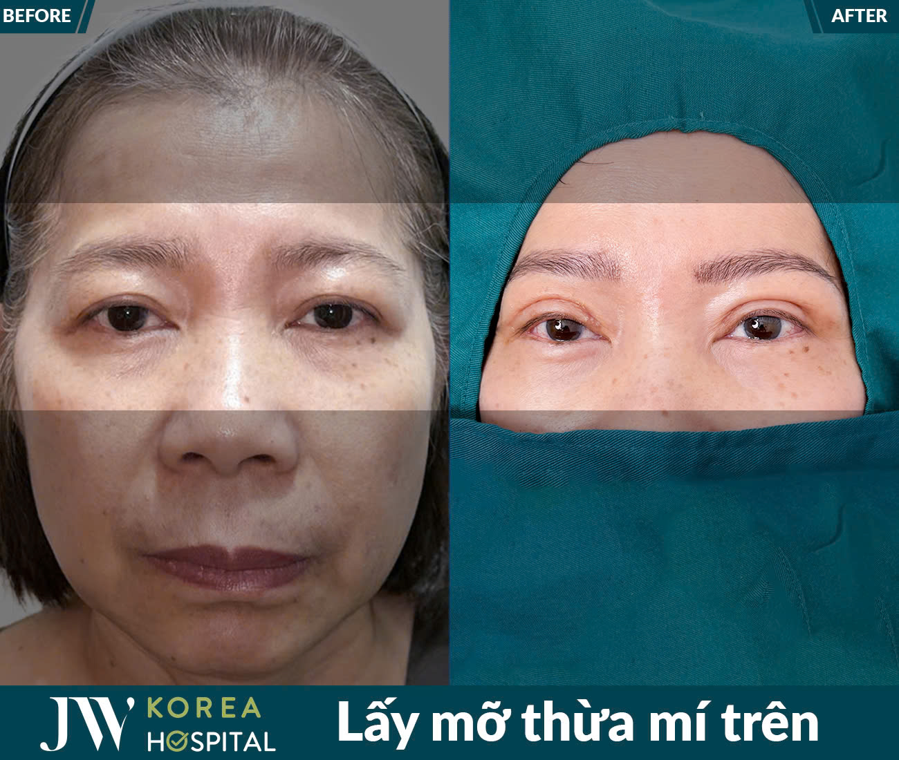 Lấy mỡ da thừa mắt