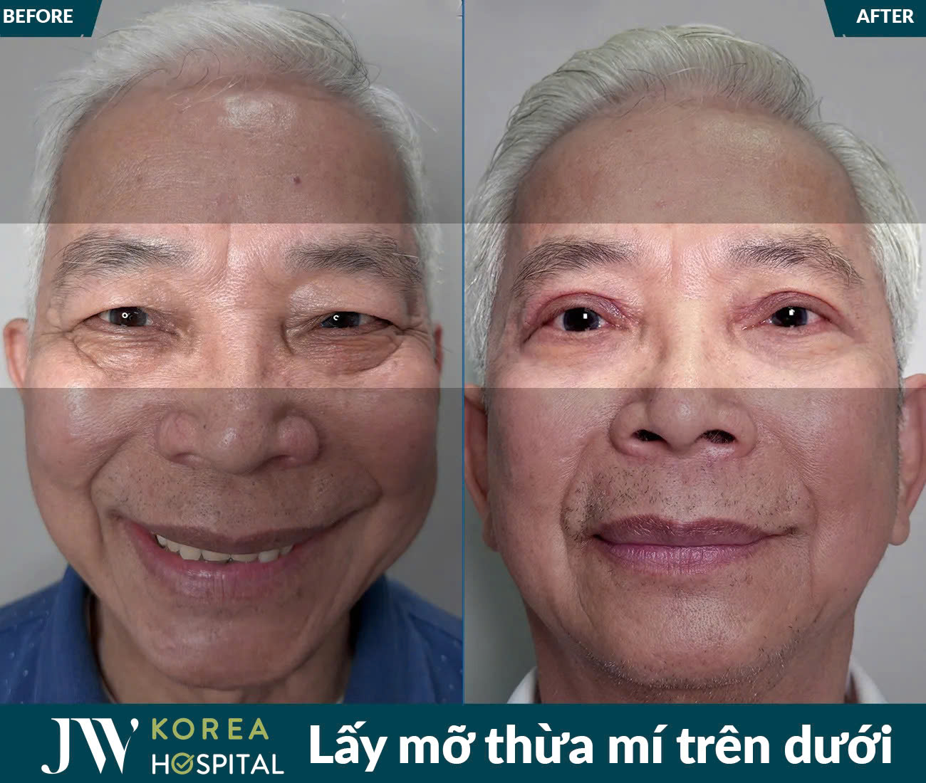 Lấy mỡ da thừa mắt
