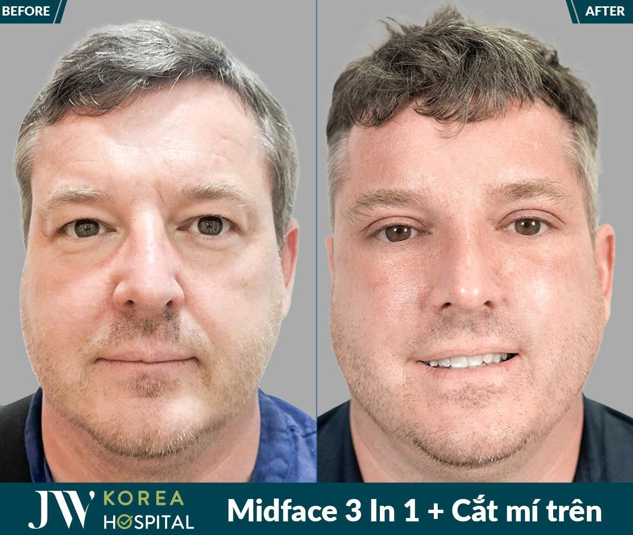 Midface 3 In 1
