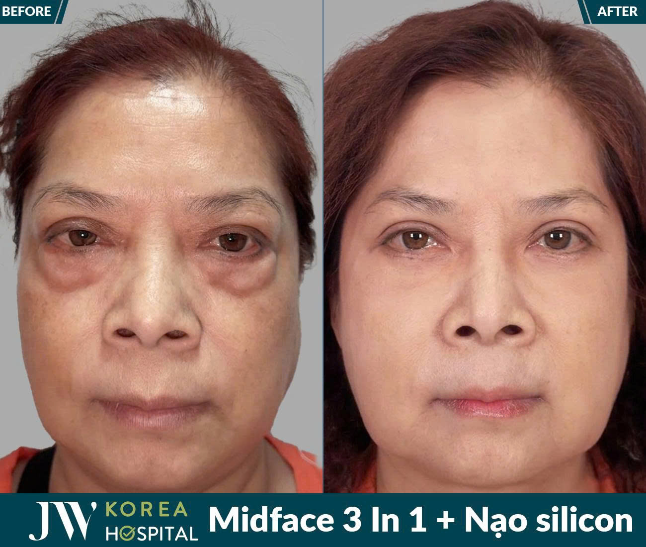 Midface 3 In 1