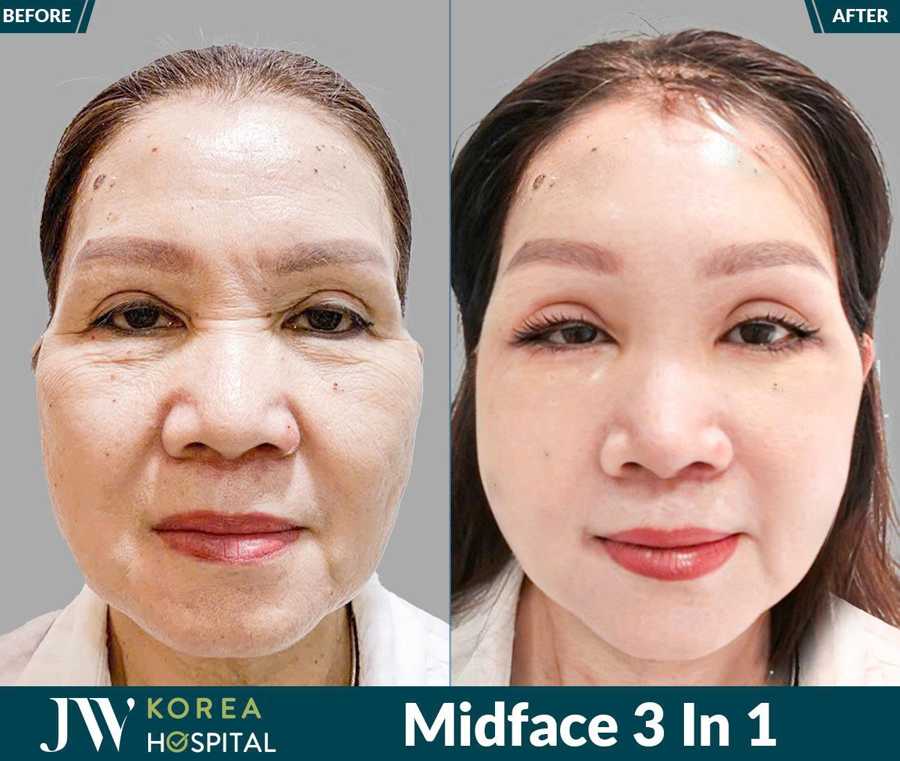 Midface 3 In 1