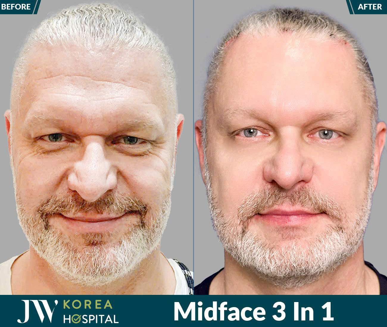 Midface 3 In 1