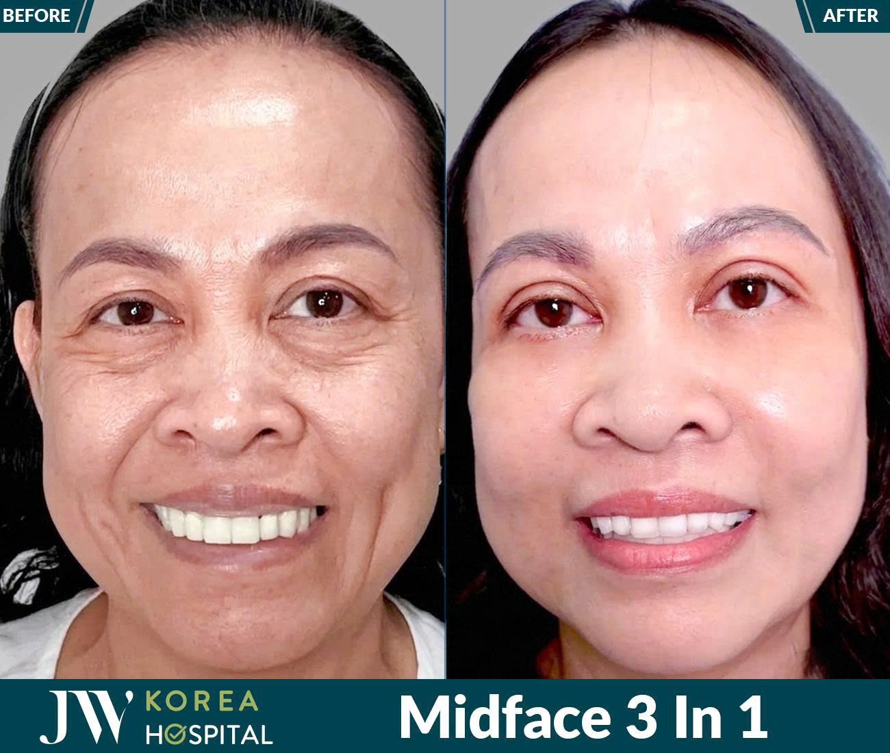 Midface 3 In 1