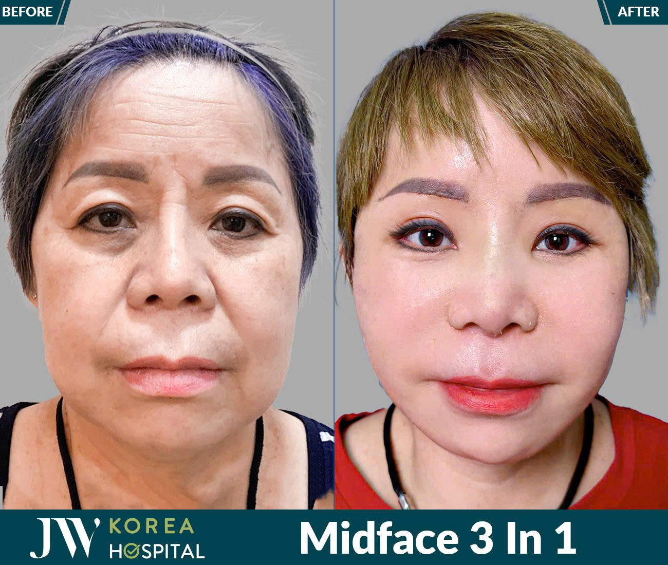 Midface 3 In 1