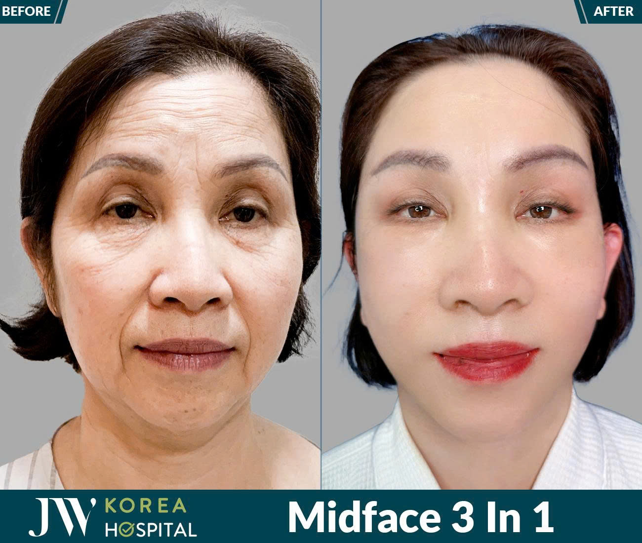 Midface 3 In 1