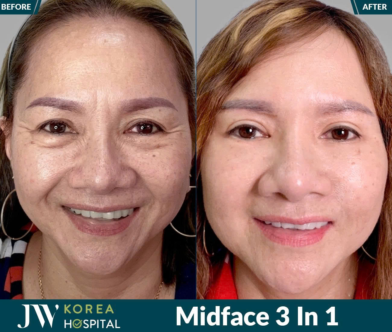 Midface 3 In 1