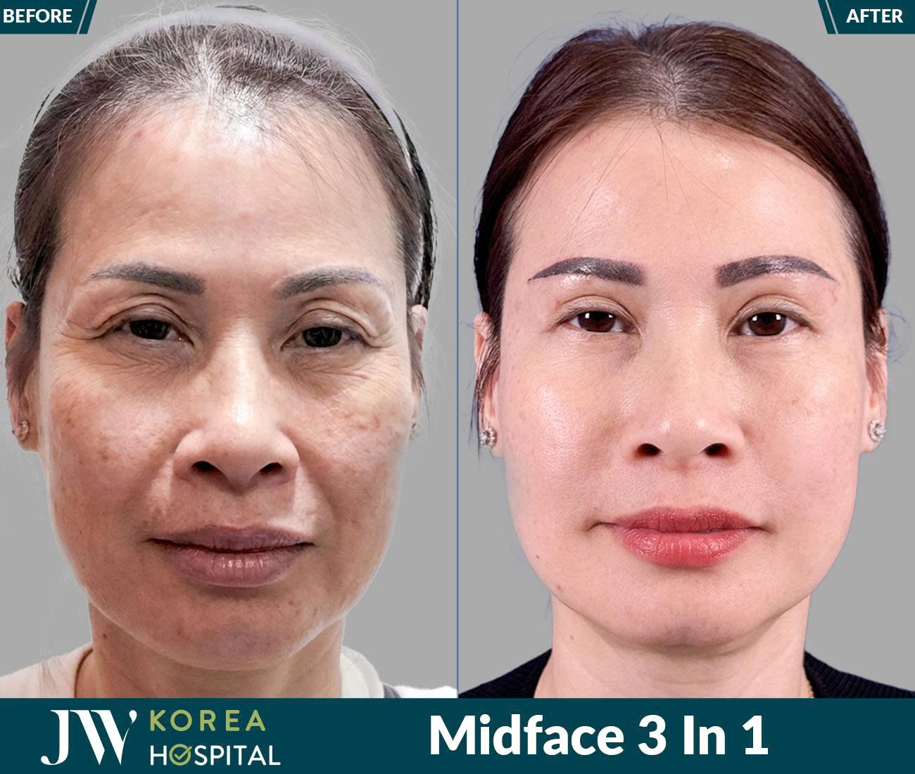Midface 3 In 1
