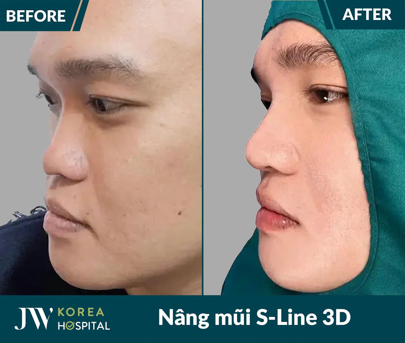 Nâng mũi S Line 3D