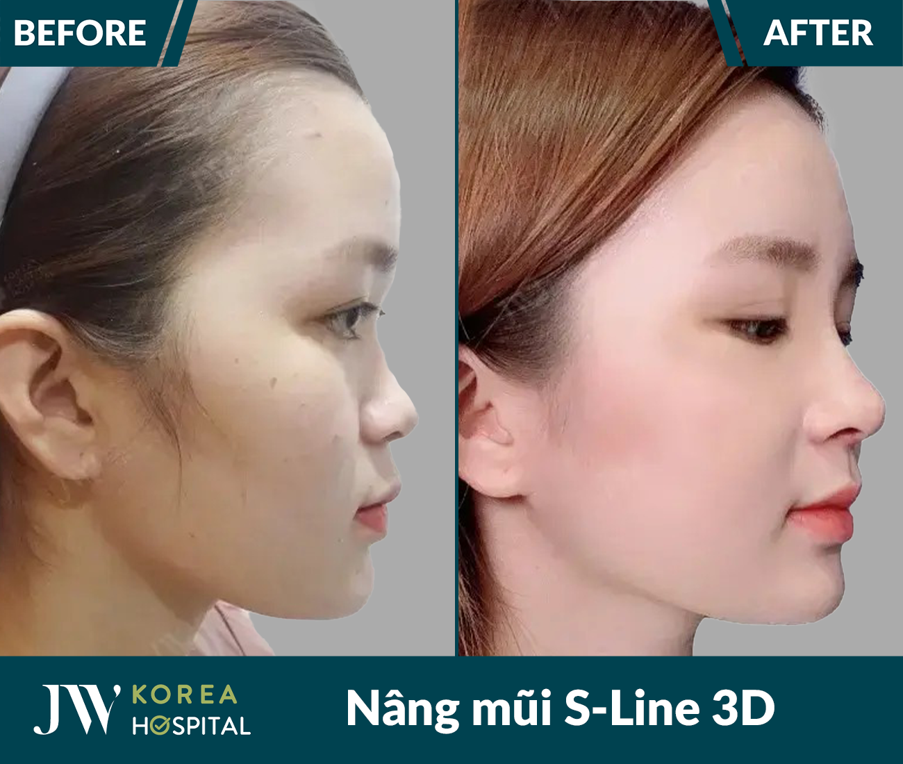 Nâng mũi S Line 3D