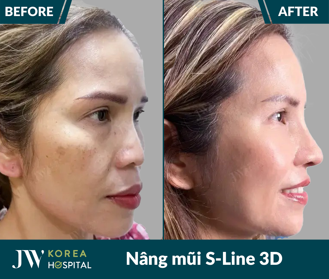 Nâng mũi S Line 3D