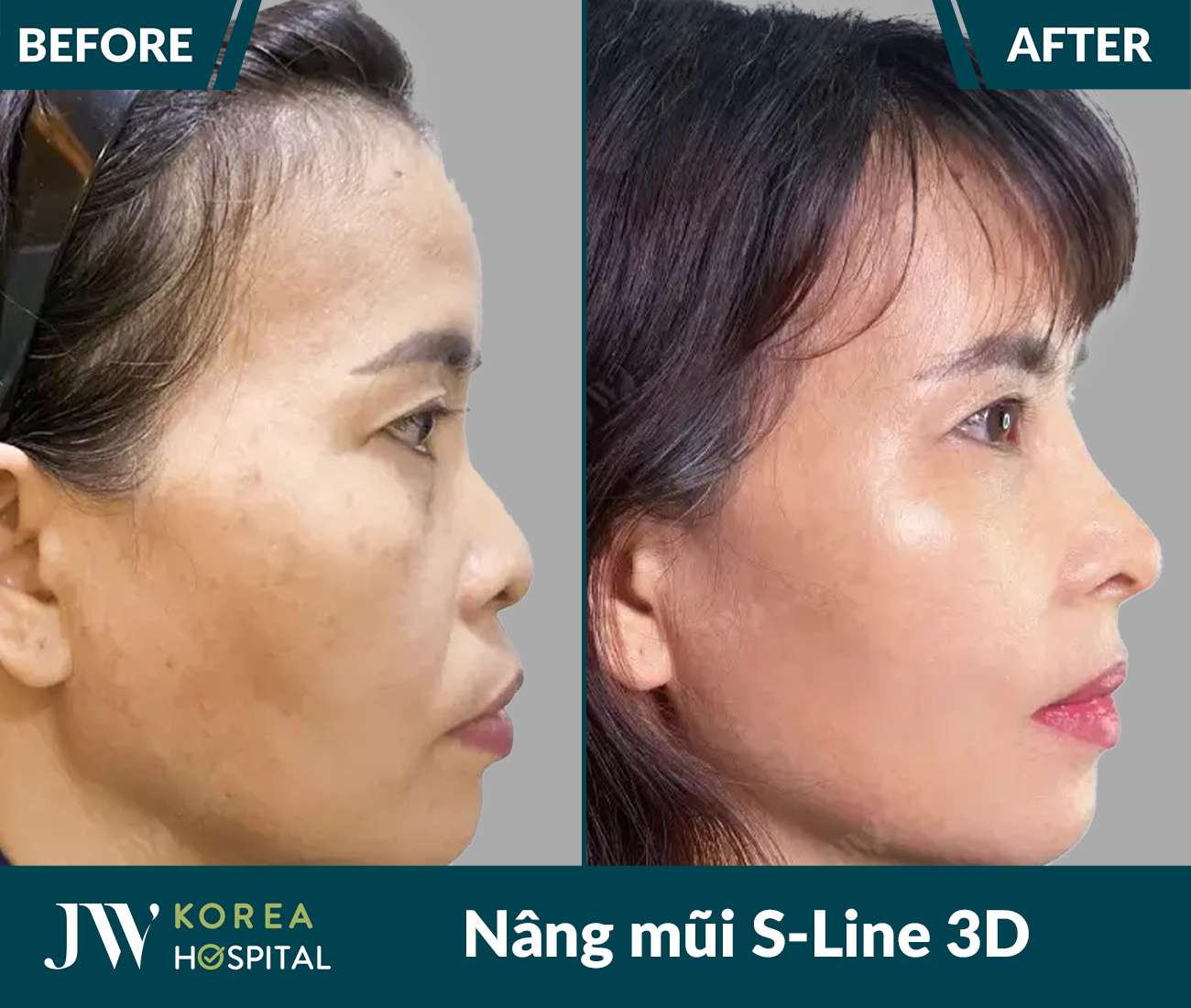 Nâng mũi S Line 3D