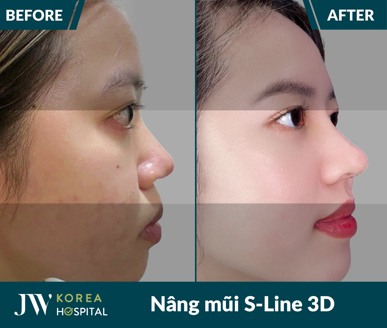 Nâng mũi S Line 3D