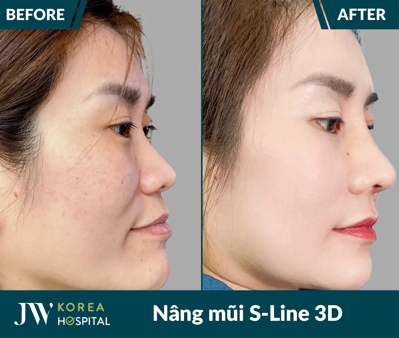 Nâng mũi S Line 3D