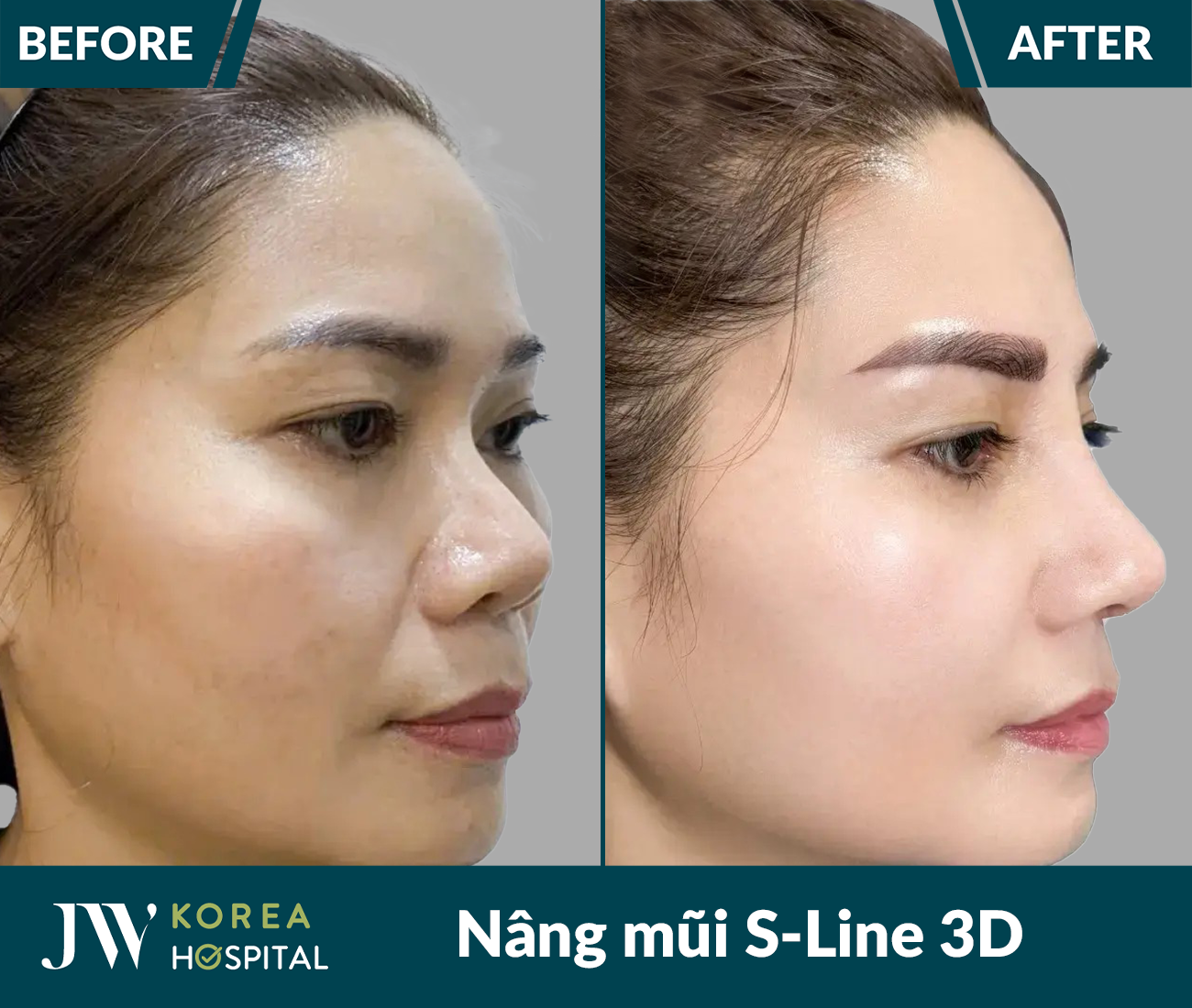 Nâng mũi S Line 3D