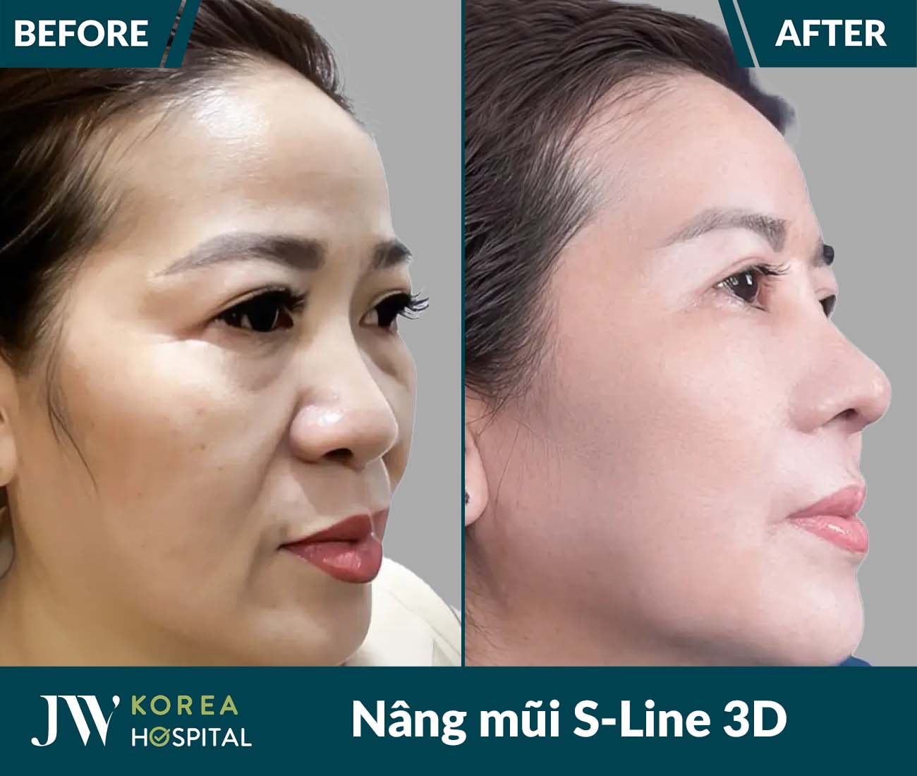 Nâng mũi S Line 3D
