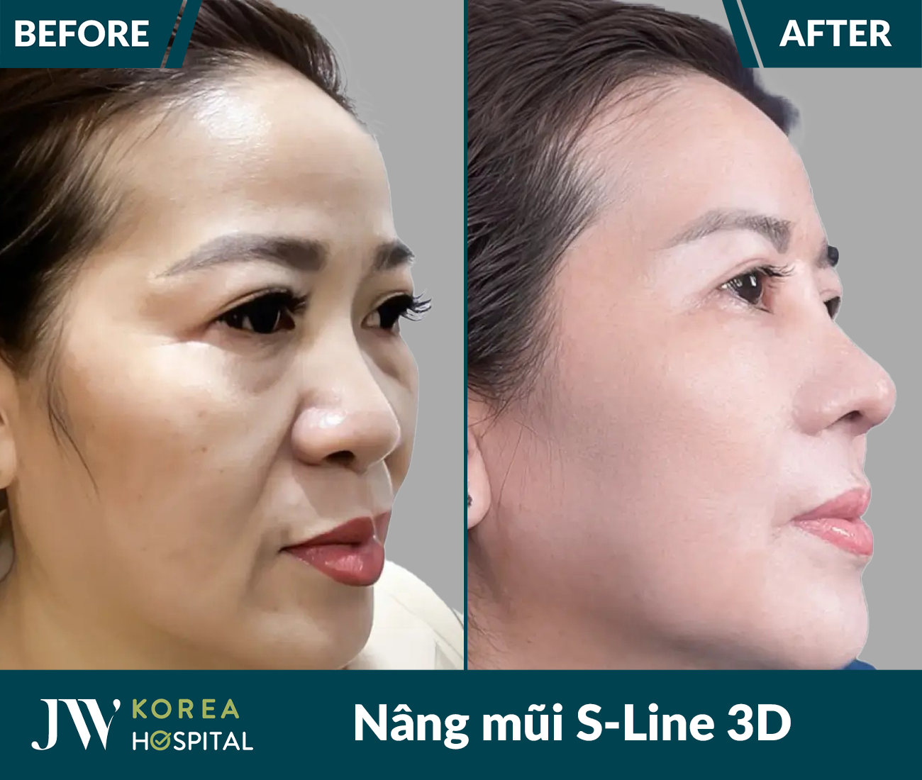 Nâng mũi S Line 3D