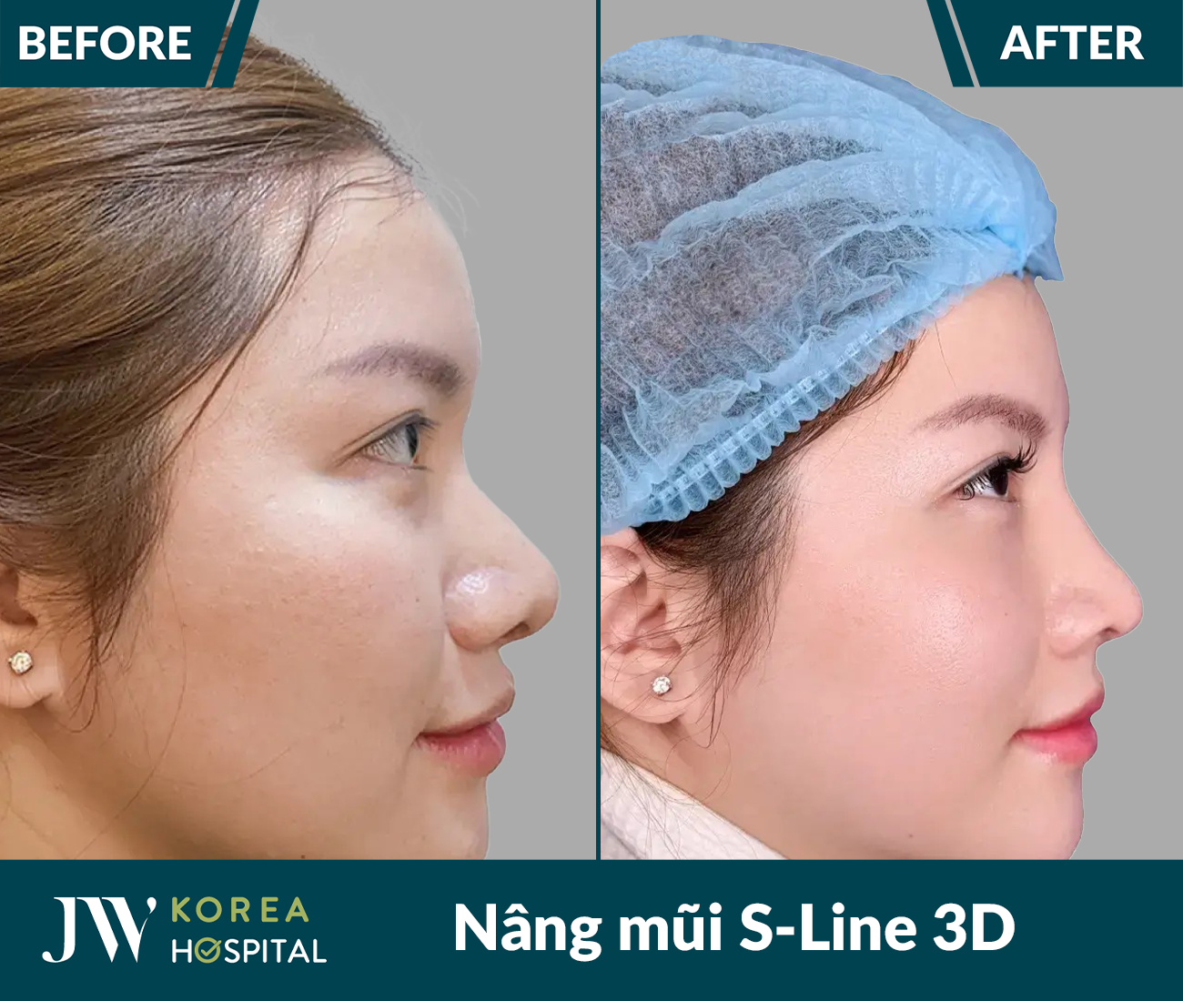 Nâng mũi S Line 3D
