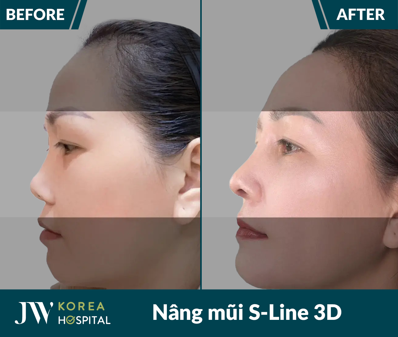Nâng mũi S Line 3D